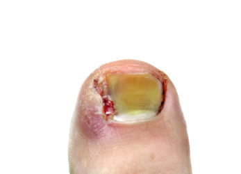 Ingrown-toenail-pedicure