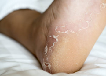 Medical-pedicure-for-foot-eczema