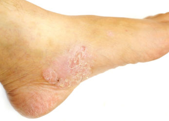 Pedicure-for-psoriasis